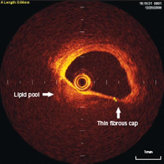 Intra-coronary imaging with OCT Lipid core mod.