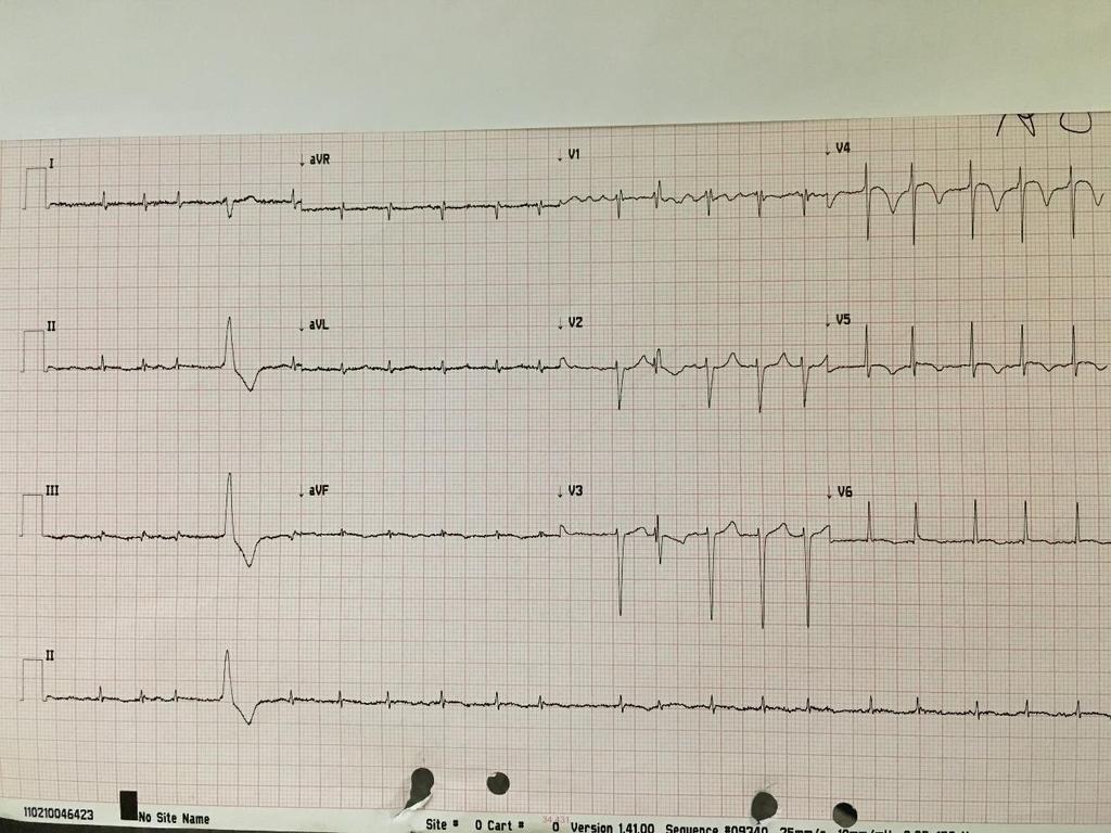 Case 5 77 yr female COPD SOB and chest discomfort New