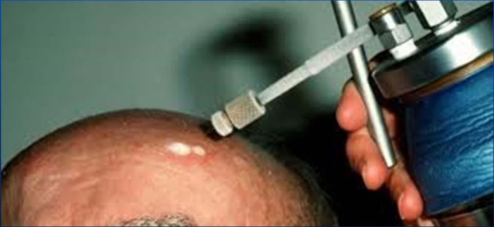 Efficacy of Cryosurgery 2004 open study 421 AK s in 89 patients 2 Variable freezing times Cure
