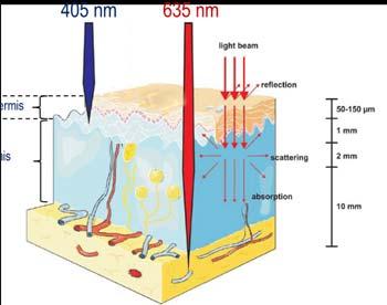 Photodynamic Therapy: New Developments 10% ALA nano-emulsion with red light