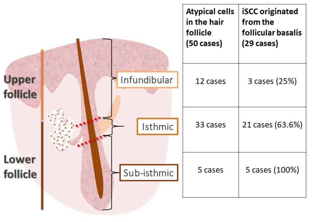 Background: Depth of follicular extension in AK correlates with depth of invasive SCC Histological review of 193 iscc cases from Badalona, Spain 63% classified as having originated from the