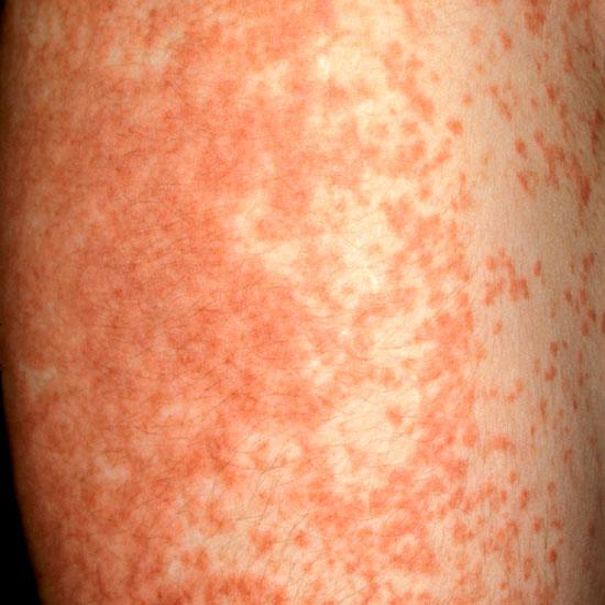 Cutaneous Drug Reactions Morbilliform or exanthematous Erythematous macules and papules Central distribution Self-limited