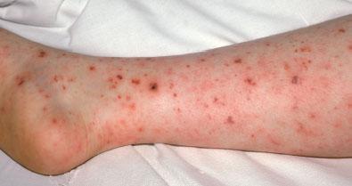 Meningococcemia Rash seen in >70% Petechiae on wrists and ankles May be