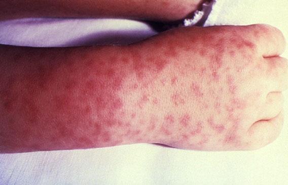Rocky Mountain Spotted Fever Rash typically appears on 4 th day after tick bite Wrists and ankles Spreads centrally to