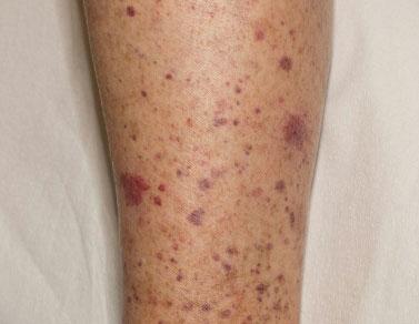 5 cm that do not blanch with pressure Purpura