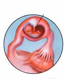 Description of some of the conditions Ectopic Pregnancy Ectopic means out of place. Ectopic pregnancy is a pregnancy which tends to grow outside the uterus. The most common site is the tube.