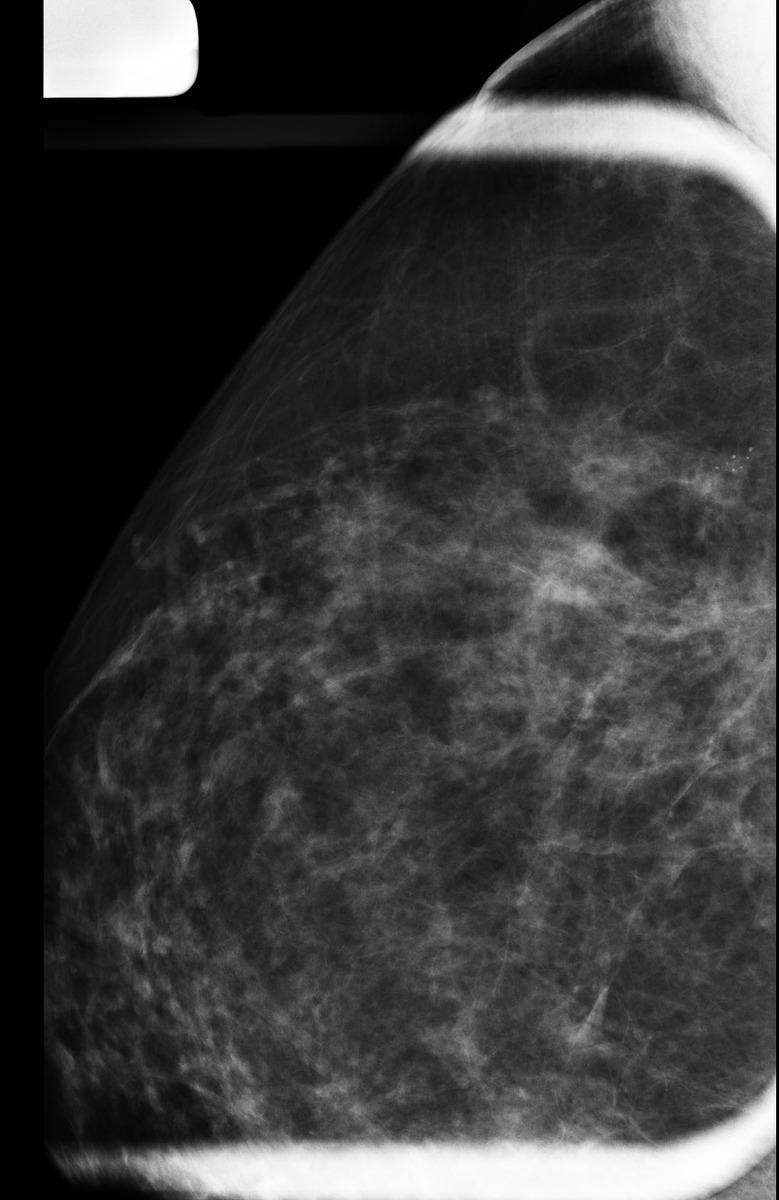 Fig. 3: Spot magnification views of the right breast demonstrate a pleomorphic group of