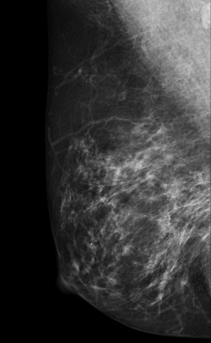 Fig. 2: RMLO view of the right breast demonstrates a group of