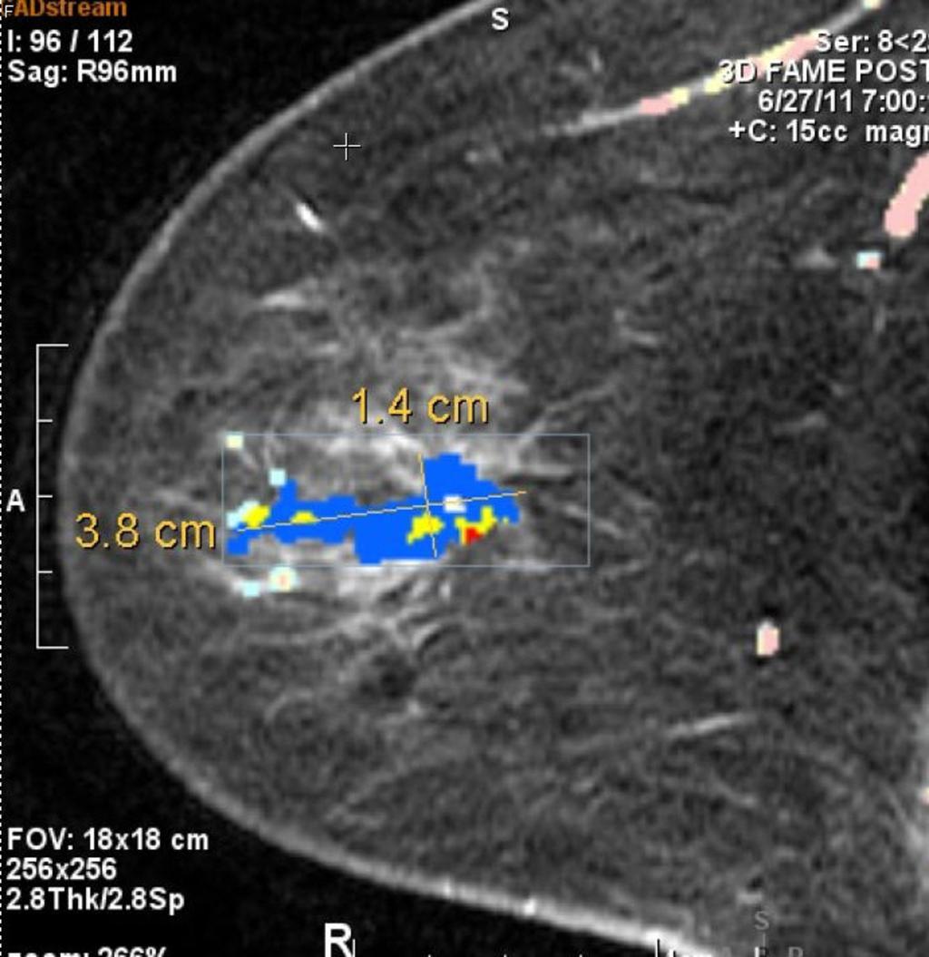 Fig. 18: Angiomap sagittal image of the right breast