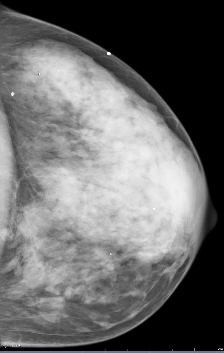 Fig. 11: Screening CC mammogram of the left breast
