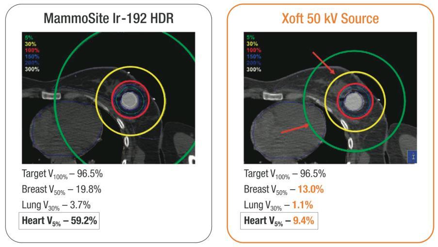 ebx High Dose, Low Energy Delivers Less Radiation to Critical Structures (heart, lung) Dickler, et al.