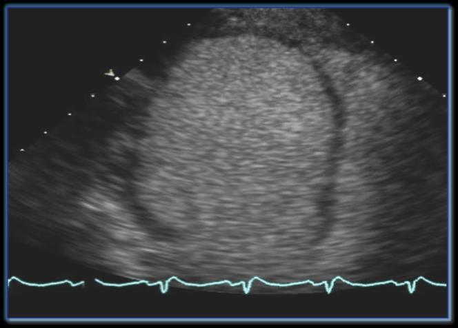 1. Define ultrasound contrast? 2. Recognize the interaction of the bubbles with ultrasound 3.