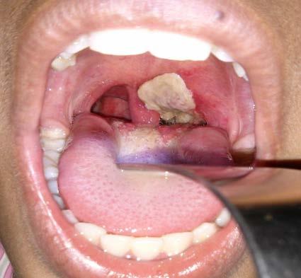 Diphtheria Diphtheria Caused by Corynebacterium diphtheriae Can involve any mucous membrane