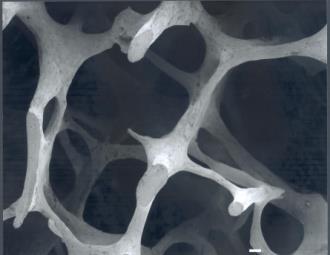 Osteoporosis Definition: A disorder due to