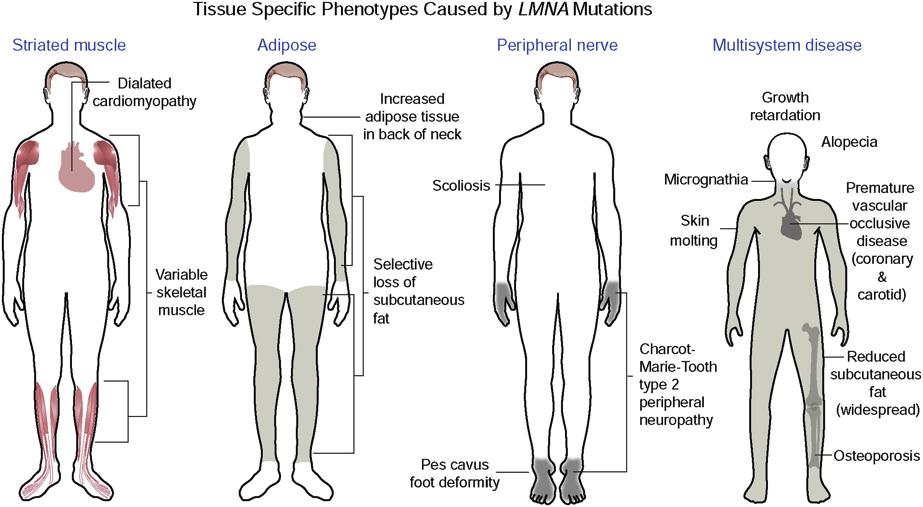 Mutations in LMNA Cause Diseases ( Laminopathies ) with Four