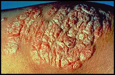 Epidemiology Male:Female equally affected Age of onset 30s and 40s Psoriasis - up to 30% have arthritis 20-40% involves spine or SI joints Arthritis may precede skin disease Psoriatic Arthritis