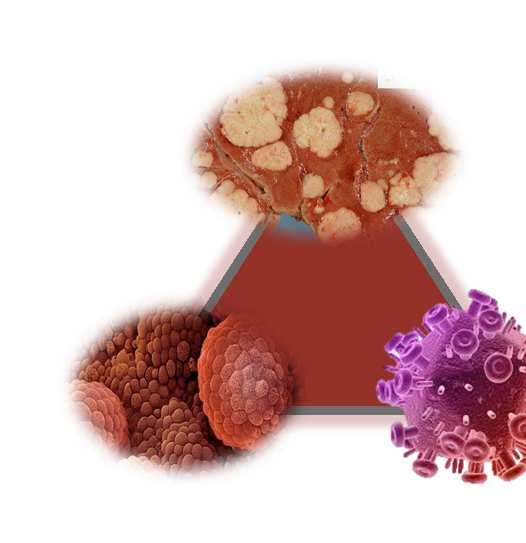 Contribution of HIV Hepatocellular Carcinoma