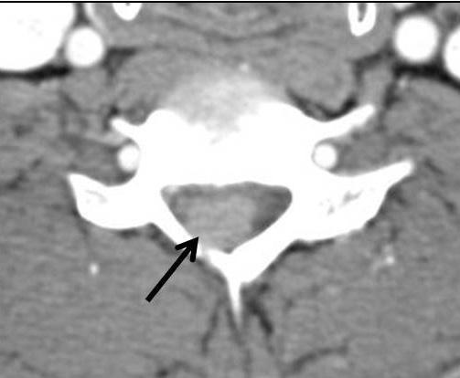 Sagittal T1-weighted MR image reveals mass having homogeneous high signal intensity, which is consistent with T1-shortening effect of