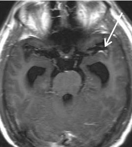 The typical MRI findings of these high cellular tumors are described to be isointense to the cord on T1WI, isointense to the cord on T2WI and intensely enhanced after contrast administration.