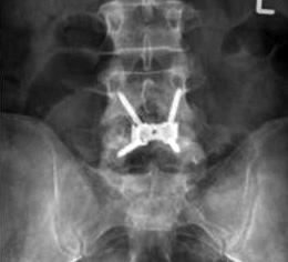 This is reported as happening in up to 15 out of 100 cases, although it is less common in the hands of an experienced spine or vascular surgeon.