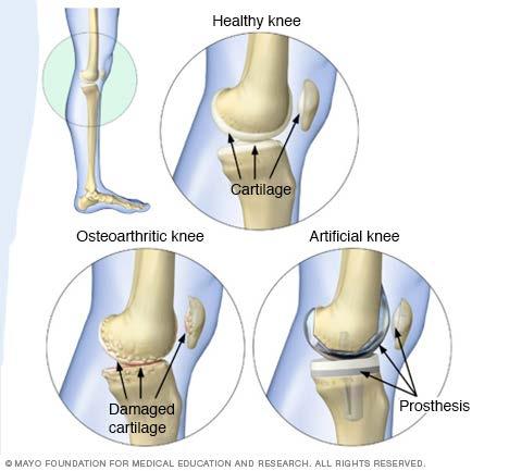 Osteoarthritis Hyperflexibility plus wear-and-tear Obesity Pain, limited mobility, decreased participation in