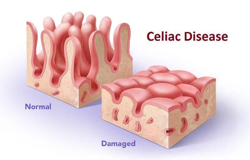 Celiac disease Autoimmune disease due to reaction to wheat/gluten products Causes damage to lining of intestine, poor absorption of