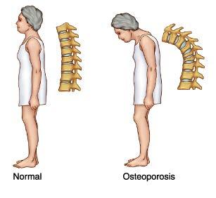 Osteoporosis Bone thinning leads to fracture Risk factors Immobility Low body mass Family history of osteoporosis, Early