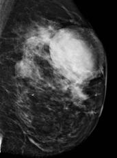 Breast cancer screening: Data and Recommendations Importance of screening mammography Breast cancer is the 2 nd leading cause of cancer death in US women NCI estimates lifetime risk of 12% based on