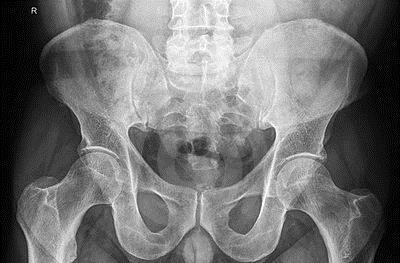 Sports hernia: diagnosis Pelvis x-ray negative.