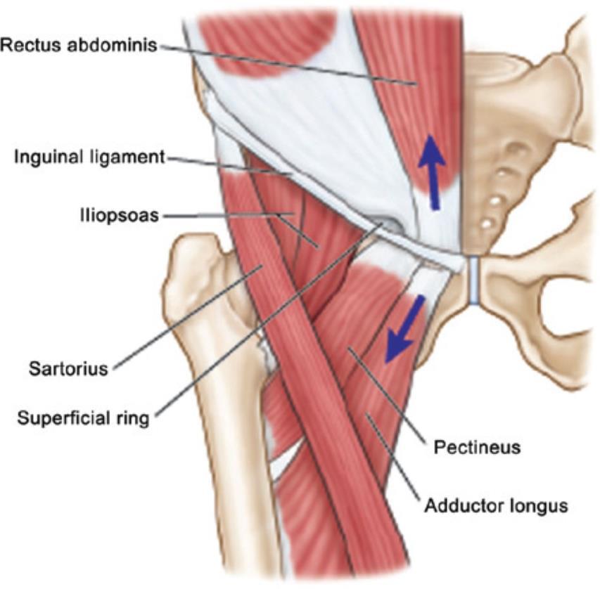 Sports hernia: pathophysiology The opposing forces of the rectus