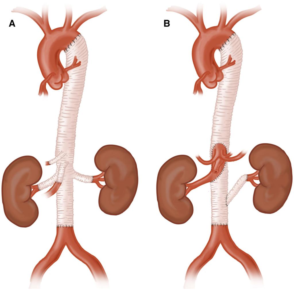 Swerdlow et al Surgical Management of Aortic Aneurysms 657 Figure 5. Open thoracoabdominal aortic aneurysm repair.