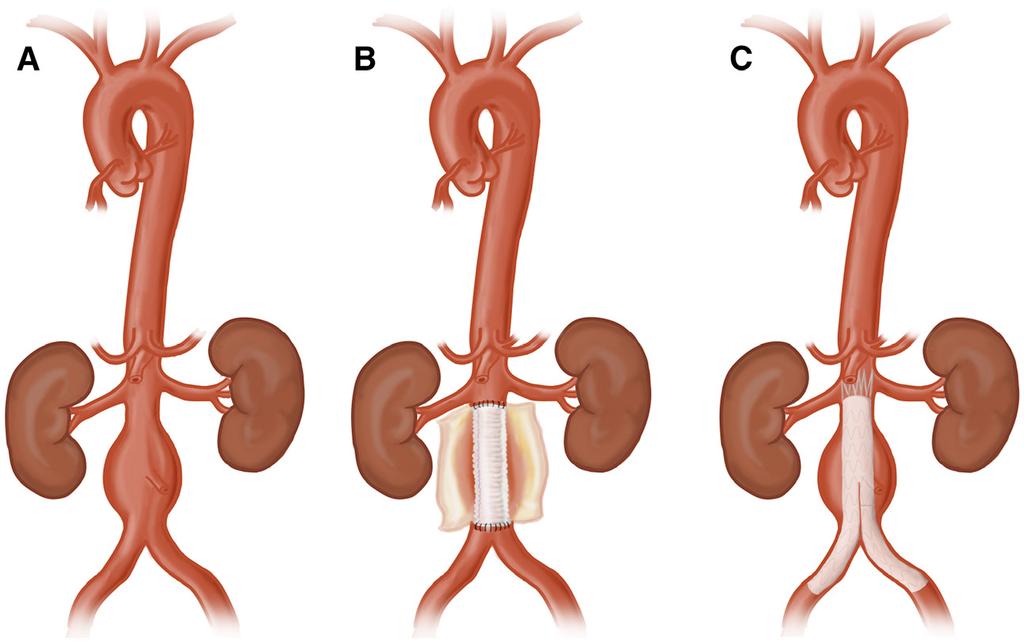 Swerdlow et al Surgical Management of Aortic Aneurysms 649 Table 2.