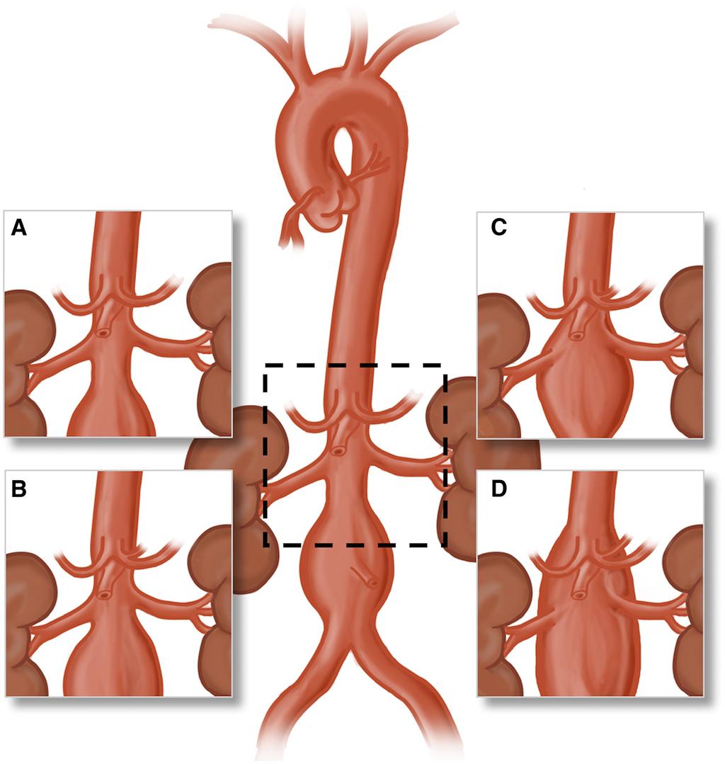 652 Circulation Research February 15, 2019 Figure 2. Classification of proximal neck anatomy of abdominal aortic aneurysms (AAA). A, Infrarenal AAA. B, Juxtarenal AAA. C, Suprarenal AAA.