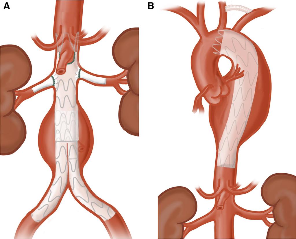 Swerdlow et al Surgical Management of Aortic Aneurysms 653 Figure 3. Endovascular repair of complex abdominal aortic aneuryms and descending thoracic aortic aneurysms.
