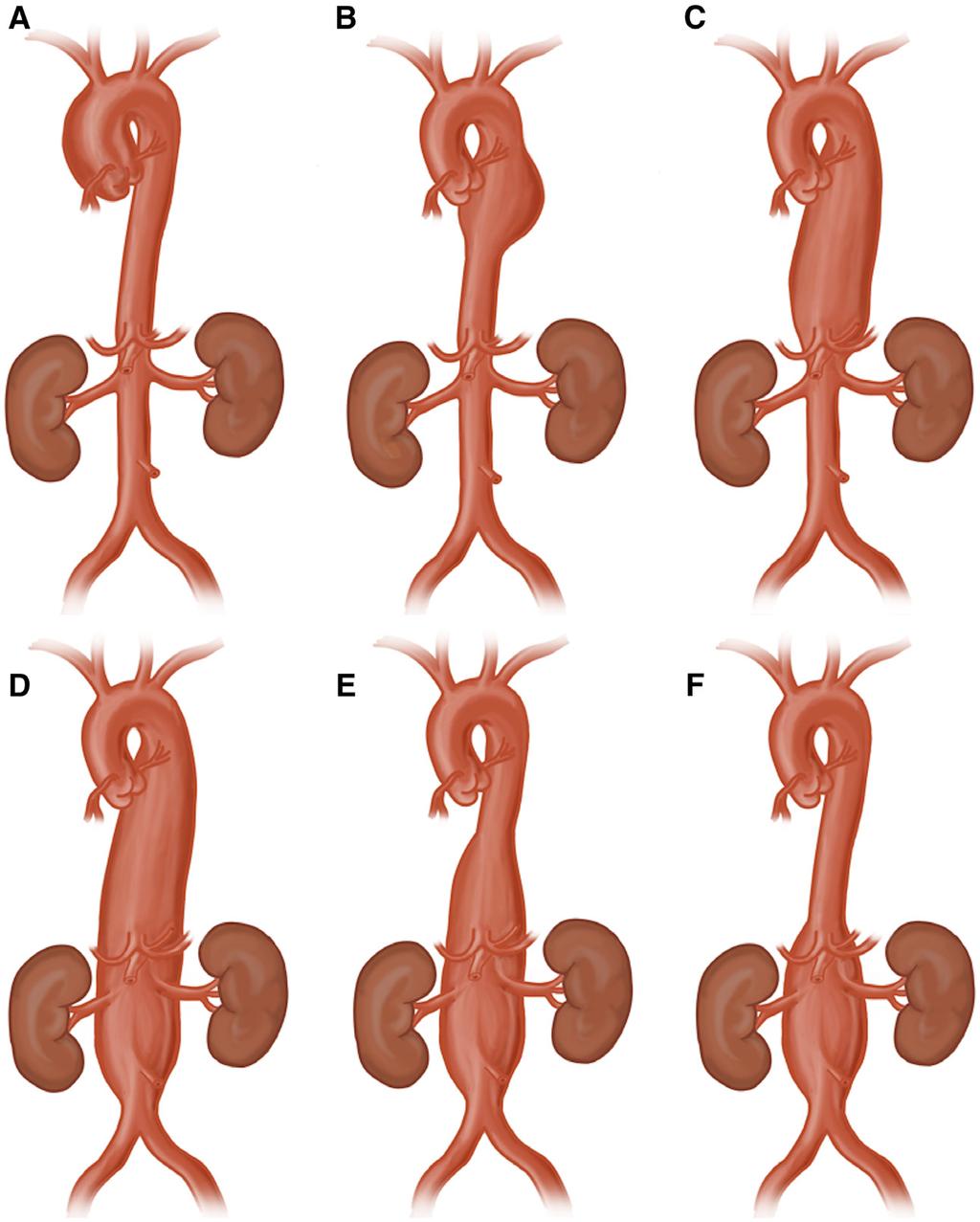 654 Circulation Research February 15, 2019 Figure 4. Anatomic classification of thoracic aortic aneurysms (TAA) and Crawford classification of thoracoabdominal (TAAA) aortic aneurysms.