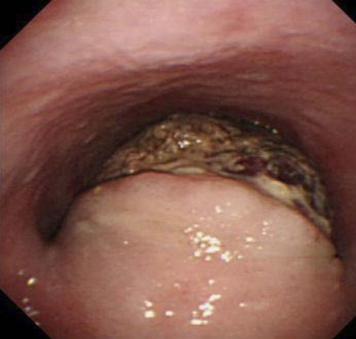 Figure 2. Endoscopic findings showed protrusion similr to sumucosl tumor with ulcertion t the posterior wll of the upper section of the esophgus. Figure 3.