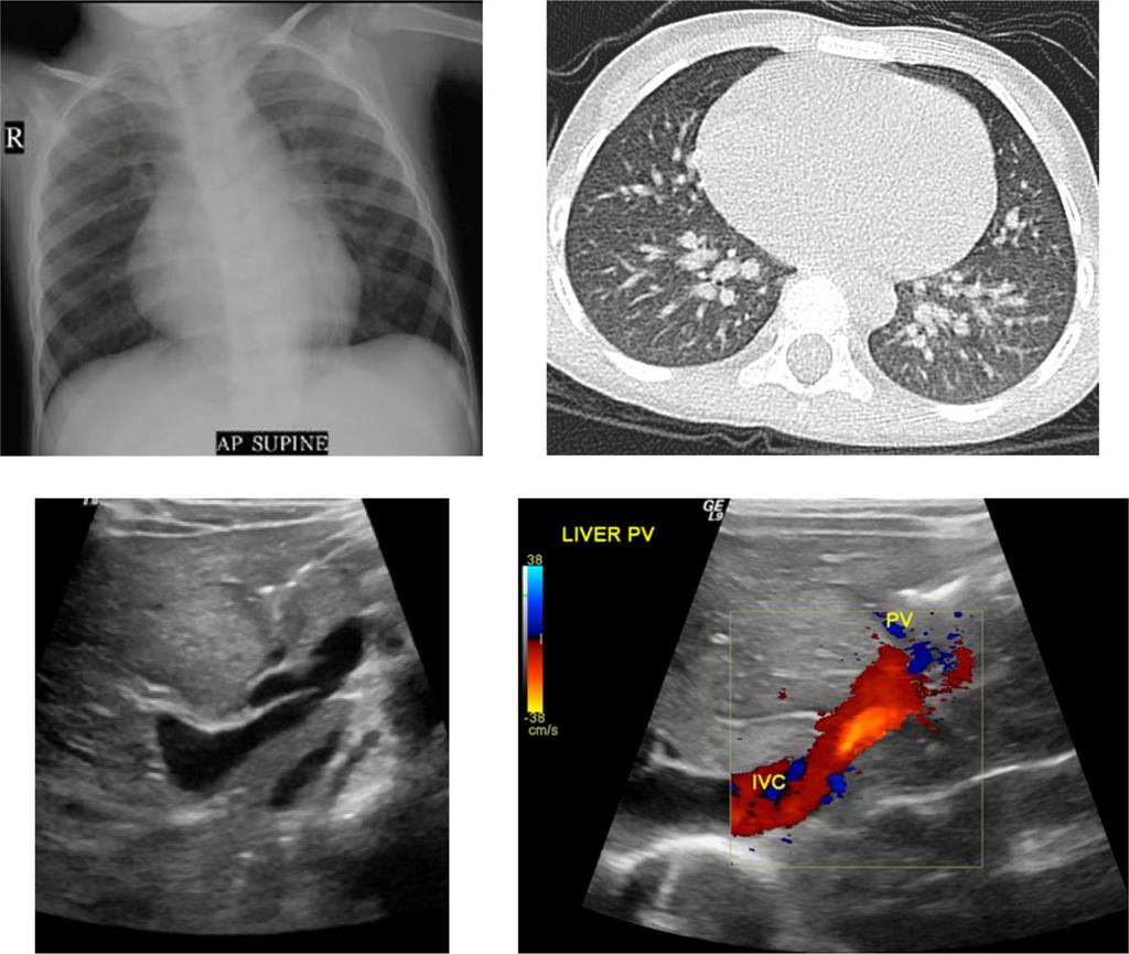 b Contrast-enhanced axial chest computed tomography image showing normal lung parenchyma with a prominent pulmonary vasculature. c Ultrasound of the abdomen showing dilated inferior vena cava.