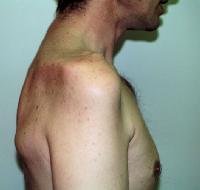 Case 3 45 year-old presenting with a history of injury to the right shoulder