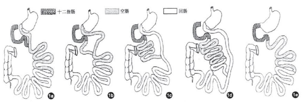 Exclusion of Various Segment of Small Intestine Duodenum