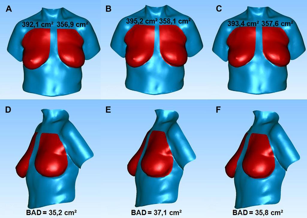 154 M. Eder et al. / The Breast 21 (2012) 152e158 437.68 116.27 cc on the left, mean SN-N: 20.09 2.44 cm on the right and 20.43 2.71 cm on the left).