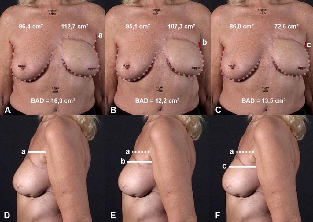 M. Eder et al. / The Breast 21 (2012) 152e158 155 Fig. 3. 2-D breast area and breast area difference (BAD) calculation in cm 2 on the exemplary breast reconstruction patient No.8 using the BCCT.
