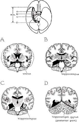 MRI of HM s Brain