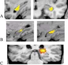 MRI of Hippocampus fmri in Virtual Maze Navigation Morphometry of London Taxi Drivers Right Posterior Hippocampal Volume Correlates