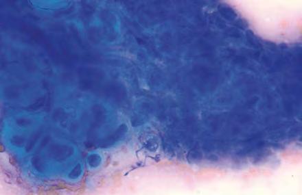 Feline oral squamous cell carcinoma: Pictured is a large cluster of neoplastic squamous cells, many of which have deeply blue, keratinized cytoplasm.