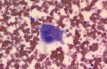 CyTOLOgy Of NeOPLASiA: AN essential COmPONeNT Of DiAgNOSiS» Peripheral nerve sheath tumors, such as neurofibromas and schwannomas.