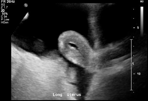 Axial (transverse) sonographic view of fluid within the endometrial canal and surrounding the uterus. Figure 3.