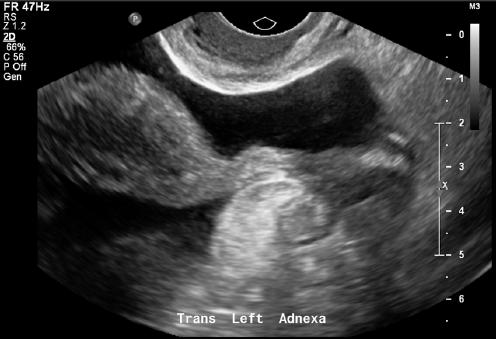 Figure 5. Sagittal endovaginal sonographic image that demonstrates fluid in the posterior cul-de-sac is appreciated.