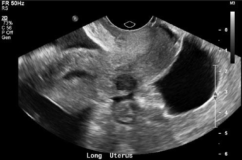 8 cm (Figures 6 and 7). There was normal hepatopetal (toward the liver) flow demonstrated within the main portal vein at the porta hepatis (Figure 8).