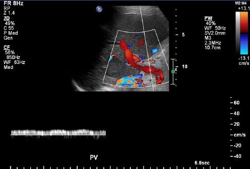 Transverse measurement and location of the mass in relation to the inferior vena cava.