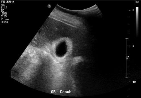 Transverse image of the liver using color Doppler to display the compression of the vessels at